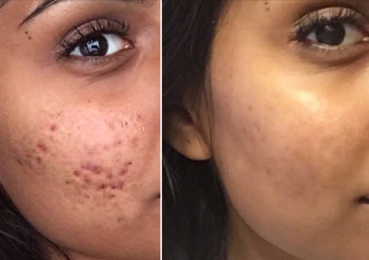 Bye Bye Acne Protocol